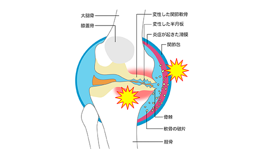 変形性膝関節症の人